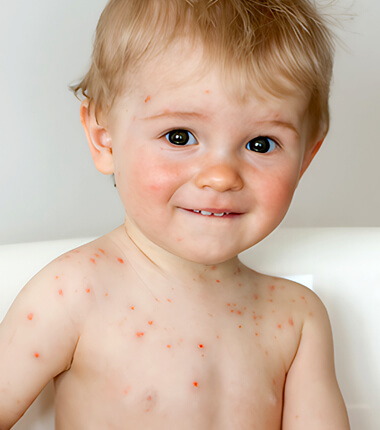 Chickenpox