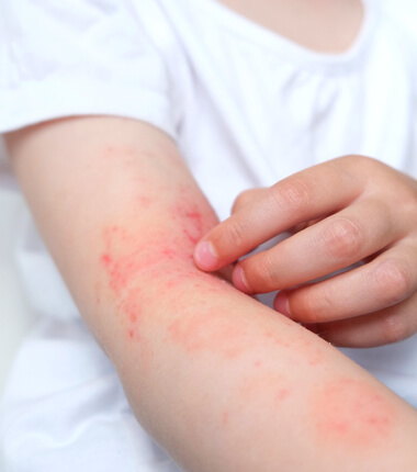 Localised Impetigo and Infected Eczema
