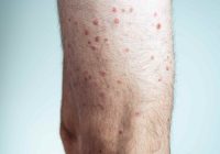 Chickenpox Protection