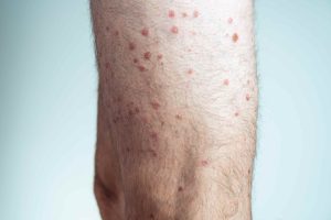 Chickenpox Protection