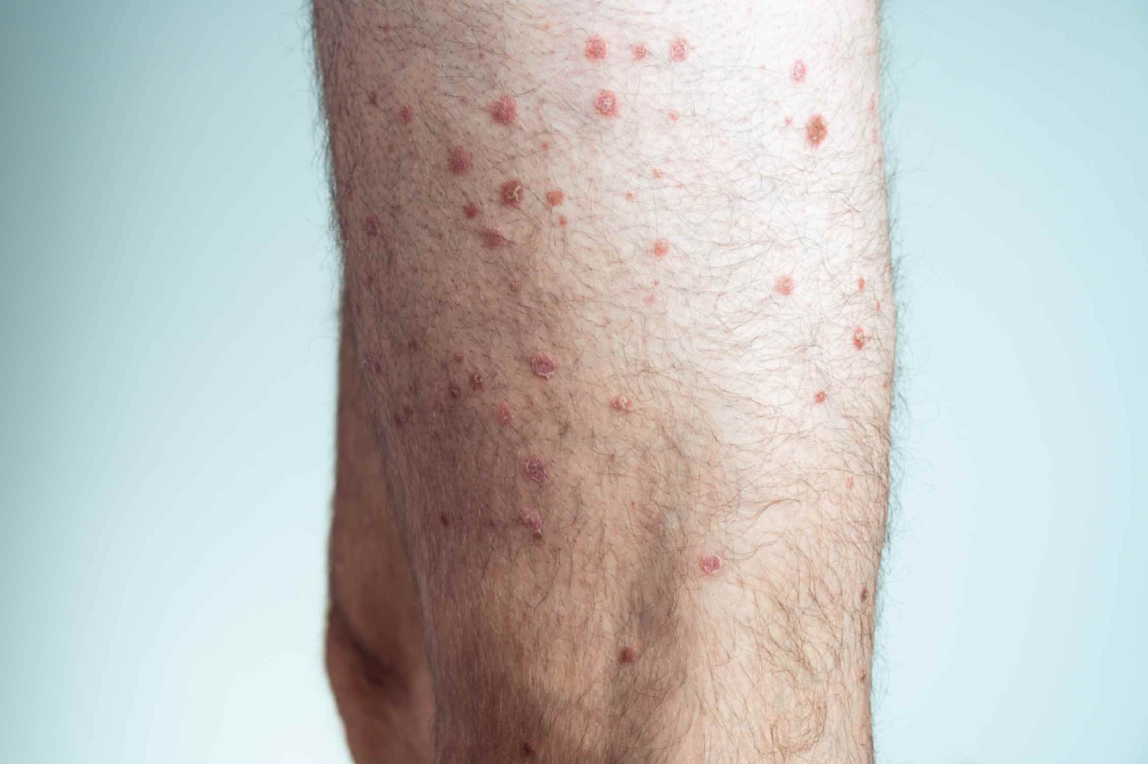 Need Fast and Effective Chickenpox Protection? Here’s How Our Vaccination Service Can Help
