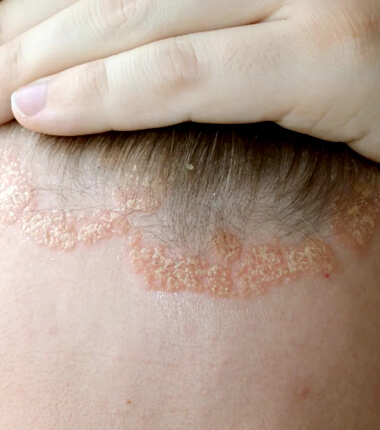 Scalp Dermatitis Treatment