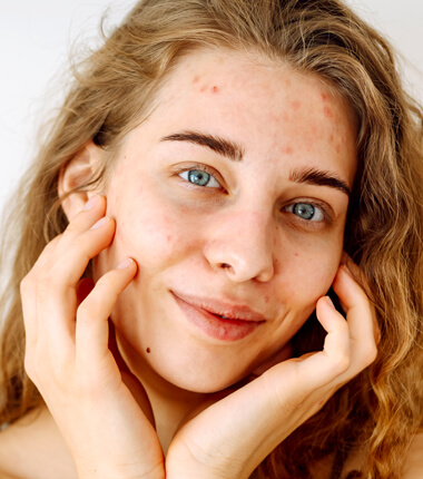 Treatment of Mild to Moderate Acne