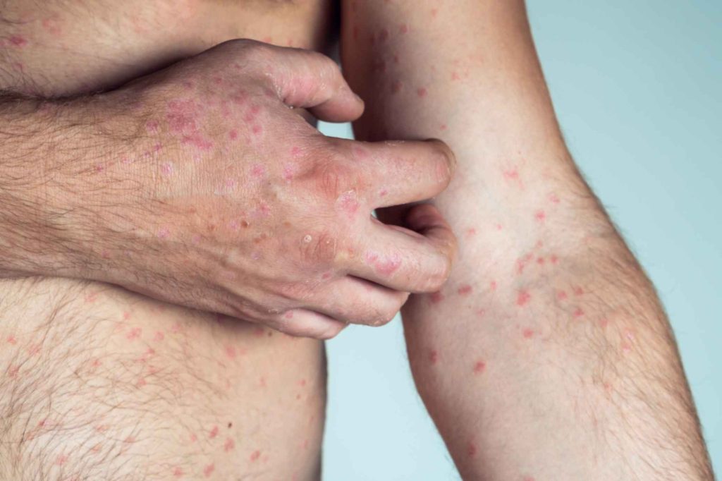 Why Catch-up Chickenpox Vaccines Are Crucial for Adults