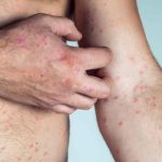 Chickenpox Vaccines