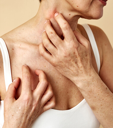 Shingles (over 50’s)